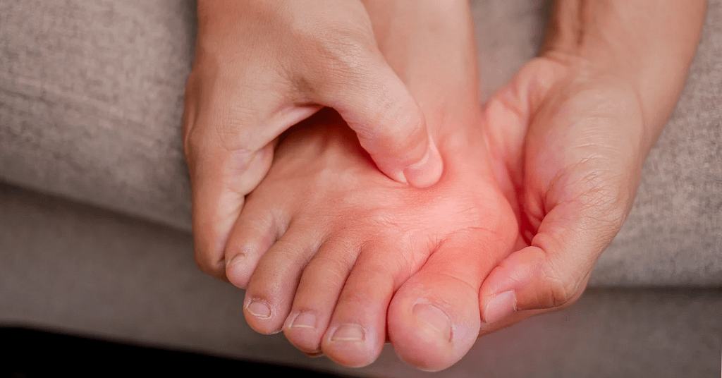 Close-up of a person holding the bunion area with redness on the big-toe joint.