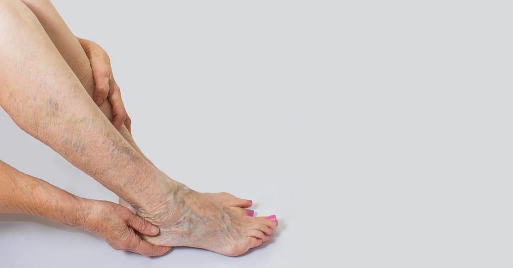 Visible veins around the ankle area while holding the foot