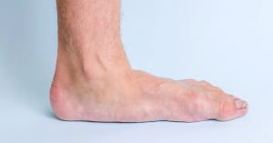 Side view of a human foot with flat arches making full contact with the ground