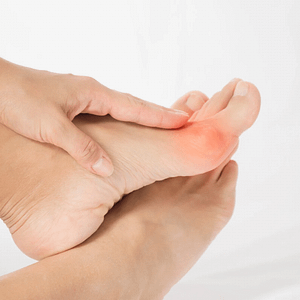 Person holding the side of the foot where a bunion causes redness and pain.