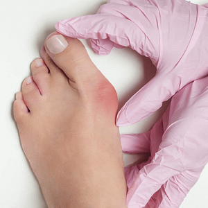 Doctor examining a red and swollen bunion at the big-toe joint.