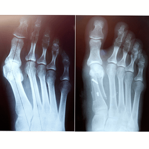Side-by-side X-ray images showing big-toe joint misalignment in hallux valgus