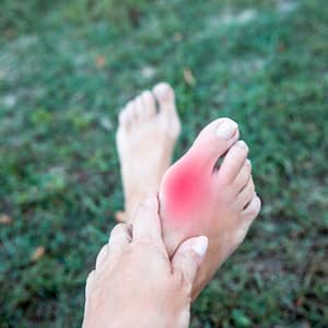 Inflamed bunion at the base of the big toe